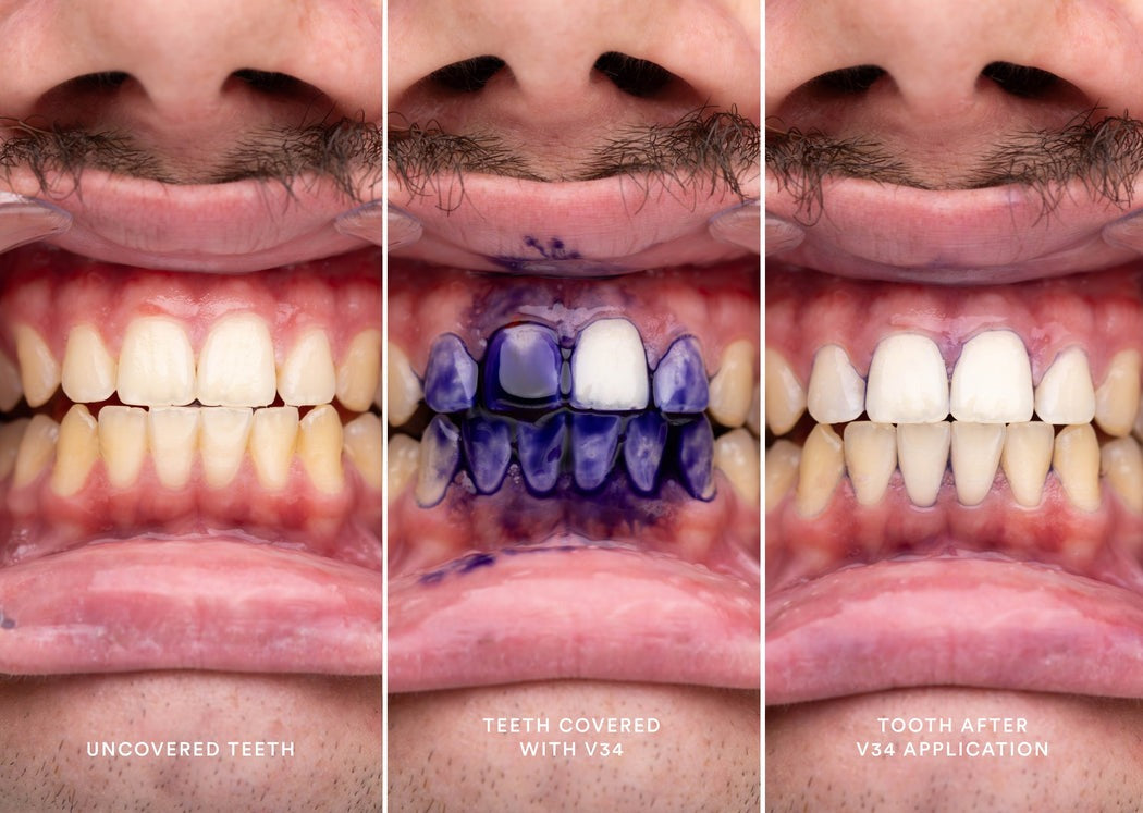 V34 Hi-Smile Teeth Whitener (RS-1295)